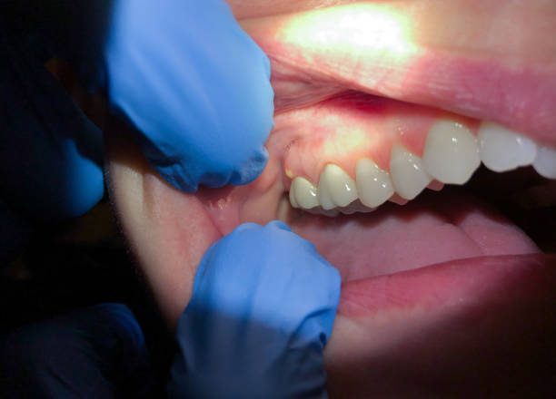 Best Cracked Tooth Emergency Dentist  in Buffalo, OK