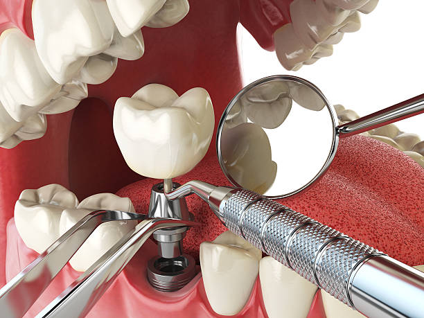 Best Teeth Whitening  in Buffalo, OK